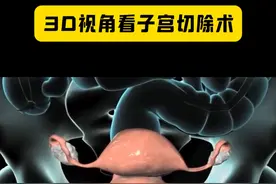 3种切除方式 #手术 #子宫 #子宫切除术 #医学3d动画 #医学科普视频封面