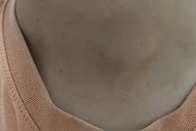 #甲状腺结节 #大脖子病 #甲亢 #微创消融 #硬核健康科普行动视频封面