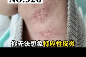 皮肤瘙痒，挠到破皮出血，#特应性皮炎 严重影响生活 怎么办 #皮肤 #科普 视频封面