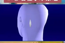 #微血管减压术 #面肌痉挛 #三叉神经痛视频封面