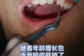 30多岁了，乳牙刚掉！ 乳牙通常在6 岁左右开始松动脱落，为恒牙腾出空间。12岁~13岁左右所有的乳牙换完。如果恒牙萌出，乳牙仍未脱落，可能需要到医院拔除。超过换牙年龄而乳牙未脱落，恒牙又未萌出者，则不要轻易拔掉，若是恒牙先天性缺失，应尽量保持乳牙，乳牙坏掉后可以考虑种牙！#种牙 #种植牙视频封面