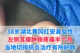 这位湖北红安的患者，左侧耳瘘肿痛半个月，症状好转从工作地点惠州，来武汉寻求我的治疗#医学科普 #耳前瘘管 #硬核健康科普行动  #武汉陈金辉视频封面