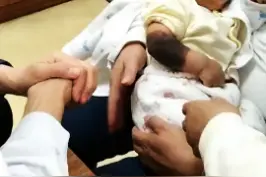 小婴儿的手臂长了黑毛痣#胎记 #黑毛痣 #医学科普 @抖音科普 视频封面