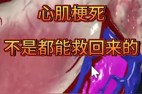 网友提问：心肌梗死后为什么做完手术以后两天人还是不行了？#心肌梗死 #在抖音pick你的健康搭子  #解锁春日健康清单  #抖出健康知识宝藏  #内容启发搜索