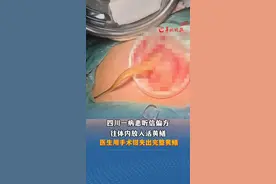 四川一病患听信偏方
往体内放入活黄鳝
医生用手术钳夹出完整黄鳝
（编辑：罗钧栋 林润祺 实习生 林曼佳 审核：dong）视频封面