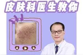 当痘肌来看医生#解毒痤疮丸 #痘痘 #口臭 #医学科普#痤疮视频封面