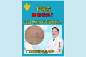 得了牛皮癣以后能根治吗？银屑病这几点让你少走弯路 #皮肤问题 #硬核健康科普行动 #广东银屑病医生推荐 #单孔荣医生 #银屑病视频封面