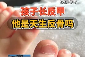 你家小孩是这种指甲吗？ #科普 #医学科普 #反甲 #反骨甲 #人类幼崽