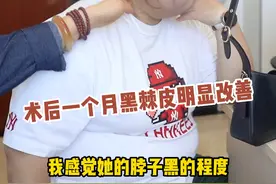 术后一个月黑棘皮明显改善#肥胖 #减重手术 #硬核健康科普行动