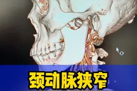 发现颈动脉狭窄，那种情况适合剥脱#颈动脉狭窄 #颈动脉斑块 #医学科普视频封面