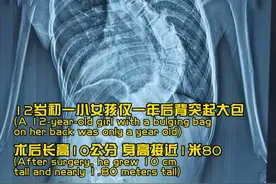 12岁女孩脊柱侧弯，“拉直”脊柱后，身高接近1米80 发现#脊柱侧弯 仅仅一年，随着青春期孩子身高进入“猛涨期”，侧弯度数也随之飙升；视频封面
