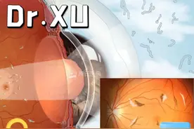 眼前出现黑点，随着眼球的转动飞来飞去，好像蚊子飞舞一样，这是什么问题呢？
#飞蚊症  #玻璃体混浊  #爱眼护眼 #徐医生谈眼说睛 #眼健康光明计划  #健闻登顶计划 #硬核健康科普行动视频封面