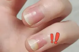 指甲空了是怎么回事？有可能是这些情况！#甲分离 #指甲空了一点 #美甲 #硬核健康科普行动