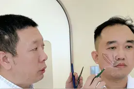 动力性鼻唇沟法令纹怎么改善？ 笑起来法令纹加重，这种法令纹如何改善？#法令纹 #鼻唇沟 #法令纹填充 #法令纹凹陷 #鼻唇沟填充视频封面