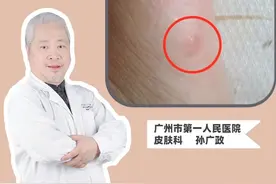 脚上总是长小水泡，反反复复特别的痒，皮肤科医生教你一招处理#皮肤 #科普 #联苯苄唑喷雾 视频封面