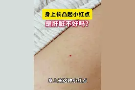 身上长凸起的小红点，是肝脏不好或身体不好？#医学科普 #健康 #科普 #樱桃状血管瘤 #生活小常识视频封面