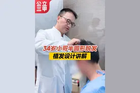 34岁小哥半圆形脱发，植发设计讲解 #脱发 #植发 #头发稀疏 #毛发种植 #江华医生团队视频封面
