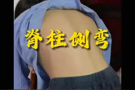 青少年脊柱侧弯，剃刀背，因发现不及时，内容很长都是干货！！ 家长有集中侧弯的小朋友家长一定要耐心看完，及时配合康复锻炼矫正~#青少年脊柱侧弯 #剃刀背 #青少年脊柱侧弯训练 #朱烱伟 #硬核健康科普行动视频封面