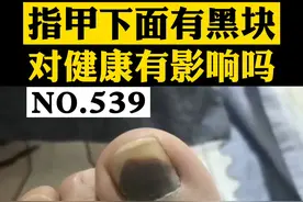 脚趾甲长了块黑印子，是身体健康出了问题吗？#科普 #指甲 #健康 视频封面