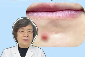 下巴长硬硬的痘，过几天还会冒出白色脓头，医生教你正确处理#医学科普 #皮肤 #痘痘 #祛痘