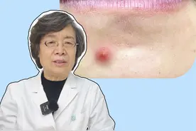 下巴长硬硬的痘，过几天还会冒出白色脓头，医生教你正确处理#医学科普 #皮肤 #痘痘 #祛痘视频封面