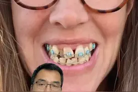 #正颌 #正颌手术记录 #刘琦武大口腔正颌 #医疗创作者培优计划