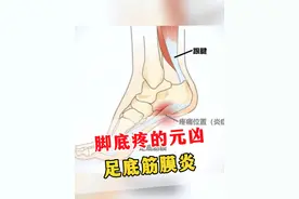 脚底疼的元凶找到了，足底筋膜炎！ #足底筋膜炎 #脚疼 #科普 #涨知识视频封面