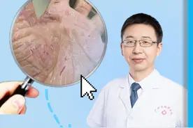 手指干燥开裂，听医生一句劝变懒才能好得快。#角化型湿疹 #湿疹 #抖出健康知识宝藏视频封面