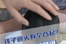 孩子额头有个凸起，很可能是额缝早闭！ #额缝早闭 #颅缝早闭 #儿童脑科小米大夫 #硬核健康科普行动视频封面