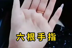 一只手有六根手指，这是天生的！ #六指 #科普 #涨知识