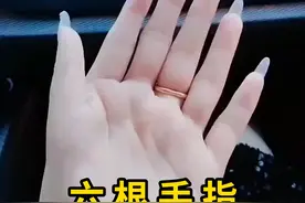 一只手有六根手指，这是天生的！ #六指 #科普 #涨知识