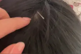 女友陪男友扎针灸俩小时后，发现一根针医生忘取，扎在男友脑袋上，女友帮忙取针，小伙眼神都变清澈了。 来源@清风啊 #男友 #搞笑 #女友 #扎针视频封面