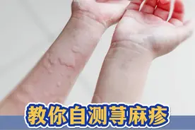 一冷、一热、一激动，身上就发红发痒，这可能是#荨麻疹 #皮肤健康 #医学科普 #dou来涨健康知识    视频封面
