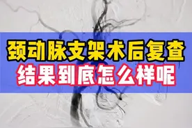 颈动脉狭窄支架术后，结果怎么样呢？#颈动脉狭窄 #颈动脉支架 #医学科普视频封面