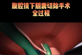 #视频仅供参考如有不适请线下就医  #肝胆外科张玉斌  #胆结石  #肝胆外科张玉斌主任每周一全天门诊#胆囊息肉