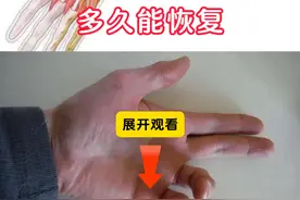 一般情况下，咱们骨折尺神经损伤后的小手指麻木，它的恢复时间可能在数月到一年，甚至更长。这是因为神经损伤的恢复通常要比骨折本身的愈合要慢得多。咱们说尺神经损伤的最佳治疗恢复期通常为伤后的三到六个月。在这个时间段内，通过积极的治疗和康复锻炼，多数患者能够有明显的症状缓解。#医学科普 #骨科 #尺神经损伤 #健康 #手麻视频封面