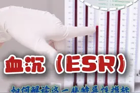 血沉（ESR）：如何解读这一非特异性指标 什么是血沉？
血沉，简单来说，就是红细胞在一定条件下沉降的速度。具体操作是将血液放在一个垂直的管子中，观察红细胞在一小时内沉降到管底的距离。这个距离以毫米/小时（mm/h）为单位表示。
血沉的重要性和应用
红细胞沉降率的检查对于疾病的诊断十分关键！它可以帮助医生：
判断疾病的活动性：比如风湿免疫性疾病、类风湿性关节炎等。
评估炎症的严重程度：特别是各种细菌感染、螺旋体感染等。
监测治疗效果：通过观察血沉的变化，了解治疗是否有效。
正常值范围
血沉的正常值会随着年龄和性别的不同而有所差异：
50岁以下的男性：一般低于15 mm/h。
50岁以下的女性：一般低于20 mm/h。
50岁以上的男性和女性：数值会有所上升，老年人的血沉测定值会随着年龄逐渐升高。
血沉升高的原因
1. 炎症性疾病
感染性疾病：如各种细菌感染、螺旋体感染等。
风湿免疫性疾病：如类风湿性关节炎、系统性红斑狼疮等胶原血管疾病，血沉往往会明显上升。
2. 其他因素
女性：通常比男性高。
贫血：贫血患者的血沉可能会增加。
终末期肾病或肾病综合征：这些患者的血沉也可能增加。
肥胖人群：肥胖可能导致血沉升高。
肿瘤相关炎症反应：血沉的升高可能与肿瘤性质、治疗效果和肿瘤活动性有关，但它是一个非特异性指标，不能单独用来诊断肿瘤。
综合判断的重要性
虽然血沉的检测非常重要，但也不能只看这一个指标就下结论哦！一定要结合其他检查结果和临床表现来综合判断。只有这样，我们才能更准确地了解自己的身体状况。
总结
血沉（ESR）作为一项重要的检验指标，能够帮助我们及早发现潜在的健康问题，特别是在炎症性疾病和风湿免疫性疾病方面。希望大家记住血沉的正常值范围，并理解其升高可能的原因。最重要的是，任何检查结果都需要结合其他检查和临床表现来综合判断，这样才能更全面地了解自己的健康状况。
#硬核健康科普行动  #血沉 #什么是血沉？ #血沉高说明什么 #医姐鸥姐视频封面