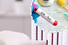 血沉（ESR）：如何解读这一非特异性指标 什么是血沉？
血沉，简单来说，就是红细胞在一定条件下沉降的速度。具体操作是将血液放在一个垂直的管子中，观察红细胞在一小时内沉降到管底的距离。这个距离以毫米/小时（mm/h）为单位表示。
血沉的重要性和应用
红细胞沉降率的检查对于疾病的诊断十分关键！它可以帮助医生：
判断疾病的活动性：比如风湿免疫性疾病、类风湿性关节炎等。
评估炎症的严重程度：特别是各种细菌感染、螺旋体感染等。
监测治疗效果：通过观察血沉的变化，了解治疗是否有效。
正常值范围
血沉的正常值会随着年龄和性别的不同而有所差异：
50岁以下的男性：一般低于15 mm/h。
50岁以下的女性：一般低于20 mm/h。
50岁以上的男性和女性：数值会有所上升，老年人的血沉测定值会随着年龄逐渐升高。
血沉升高的原因
1. 炎症性疾病
感染性疾病：如各种细菌感染、螺旋体感染等。
风湿免疫性疾病：如类风湿性关节炎、系统性红斑狼疮等胶原血管疾病，血沉往往会明显上升。
2. 其他因素
女性：通常比男性高。
贫血：贫血患者的血沉可能会增加。
终末期肾病或肾病综合征：这些患者的血沉也可能增加。
肥胖人群：肥胖可能导致血沉升高。
肿瘤相关炎症反应：血沉的升高可能与肿瘤性质、治疗效果和肿瘤活动性有关，但它是一个非特异性指标，不能单独用来诊断肿瘤。
综合判断的重要性
虽然血沉的检测非常重要，但也不能只看这一个指标就下结论哦！一定要结合其他检查结果和临床表现来综合判断。只有这样，我们才能更准确地了解自己的身体状况。
总结
血沉（ESR）作为一项重要的检验指标，能够帮助我们及早发现潜在的健康问题，特别是在炎症性疾病和风湿免疫性疾病方面。希望大家记住血沉的正常值范围，并理解其升高可能的原因。最重要的是，任何检查结果都需要结合其他检查和临床表现来综合判断，这样才能更全面地了解自己的健康状况。
#硬核健康科普行动  #血沉 #什么是血沉？ #血沉高说明什么 #医姐鸥姐视频封面