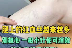 腿上的红血丝越来越多了... 别担心 一根小针便可消除，将来穿裙子好看！#硬核健康科普行动 #门诊日常 #静脉曲张 #红血丝视频封面