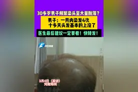 30多岁男子频繁染头至大量脱落？男子：一月内染发4次  十多天头发基本的上没了医生最后建议一定要看！快转发！#媒体精选计划视频封面