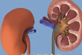 结石术后大家最关注的几个问题以及术后的预防 #肾结石 #输尿管狭窄 #微创手术 #结石预防 #硬核健康科普行动