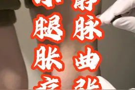 静脉曲张，小腿胀痛 #中医 #针灸调理 #放血疗法 #静脉曲张 #硬核健康科普行动视频封面
