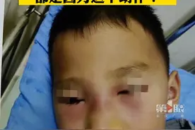 12月6日，湖南长沙，别再挖鼻孔了！#男孩经常挖鼻孔导致蜂窝组织炎 反复高烧脸部肿成馒头！视频封面