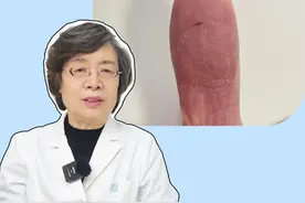 手指头起皮、裂小口，这不是简单的干燥，而是病！#角化型湿疹 #医学科普 #抖出健康知识宝藏  #家务 #手干燥粗糙视频封面