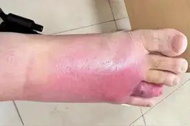 5月28日广东东莞，男子在沙发上睡了一觉，被不明昆虫咬伤，差点截肢！（东莞市石碣医院）