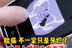 脸痛不一定只是牙烂了，或是上颌窦也发炎了 #硬核健康科普行动  #2025健康许愿池 #脸痛 #牙痛 #上颌窦炎视频封面