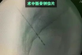 骶神经调控治疗顽固性膀胱过度活动症 术中骶骨侧位片#膀胱过度活动症 #泌尿外科  #尿控 #排尿困难 #医学科普视频封面