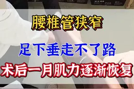 #腰椎管狭窄 #腰椎间盘突出 足下垂走不了路，大小便困难，术后一个月，逐渐恢复正常生活#科普视频封面