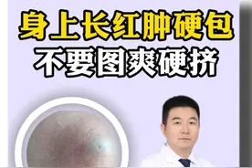 身上长红肿硬包，不要一时图爽硬去挤它#粉瘤 #皮脂腺囊肿 #长包 #抖出健康知识宝藏视频封面