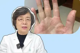 女性单个手掌干燥脱皮 、有红斑，又疼又痒，这是真菌感染导致的#手癣 ，要尽早治疗！#鹅掌风 #皮肤 #医学科普 #女性
